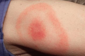 The rash is often described as looking like a bull's-eye on a dartboard